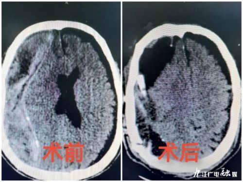 九江市中医医院成功运用双镜联合微创清除罕见复杂慢性硬膜下血肿