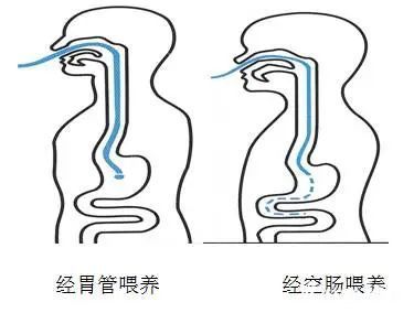 鼻胃管置管术图片