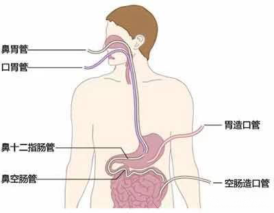 插胃管流程图图片