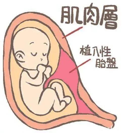 胎盘植入示意图图片