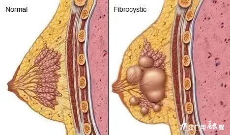 乳腺瘤的症状与图片图片