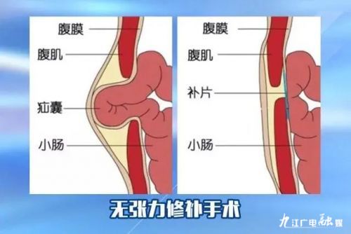 各种老年疝气图片图片